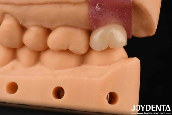 4.1mm V en forme de fil Abutments en titane avec connexion hexagonale interne