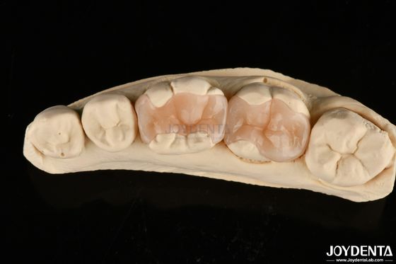 Inlay dentaire en porcelaine polymérisée naturelle pour la restauration des dents