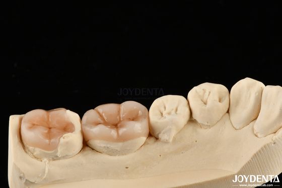 Régénération dentaire naturelle composite en incrustation en incrustation avec apparence naturelle