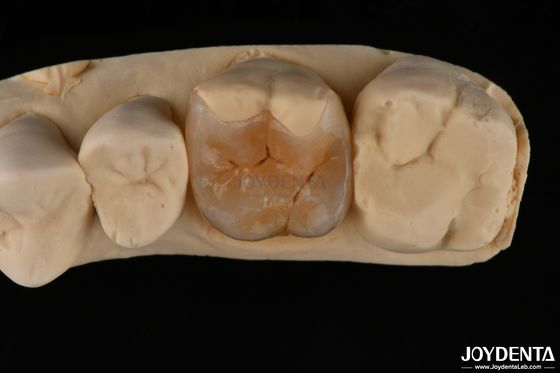 Inlay composé personnalisé pour la restauration dentaire minimalement invasive
