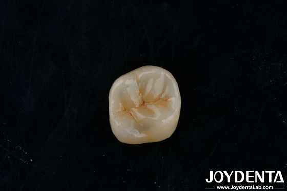 Adhésifs personnalisables en zirconium, incrustés en onlays à haute translucide pour la restauration