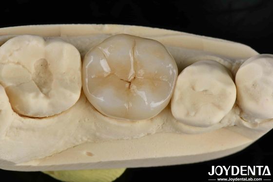 Cimentation adhésive en zirconium incrustations et onlays dentaires naturels
