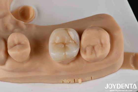 Inlay et onlay dentaires en zirconium de haute résistance pour la restauration des dents