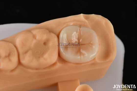 0.5mm-2mm Précisément ajusté Emax Dental Inlay Onlay pour une restauration dentaire fiable