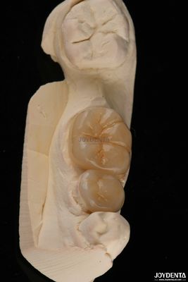 Les incrustations et les incrustations dentaires Emax résistant aux fractures 1,5 mm faible translucide