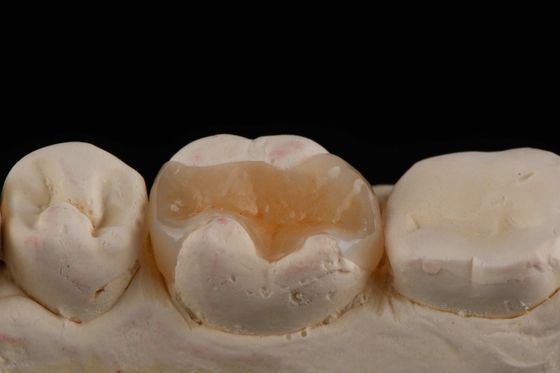 E Max Matériel Inlay et Onlay en dentisterie Restauration esthétique Durable