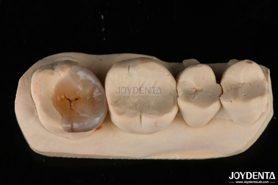 Des incrustations dentaires Emax personnalisées et naturelles pour la restauration des dents