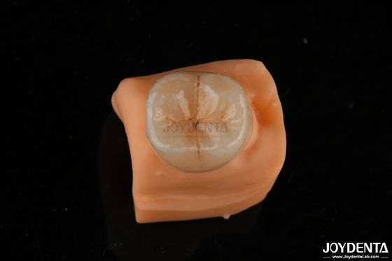 0.5mm Résistant aux taches Emax Inlay Onlay Convient pour les restaurations dentaires