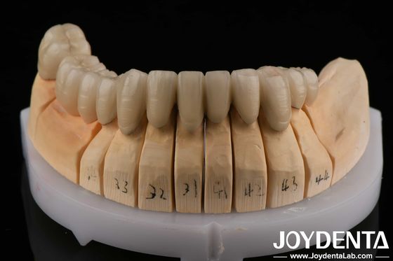 Porcelaine PFM en alliage d'or fondue dans du métal pour les soins dentaires Compatible avec la couche de porcelaine