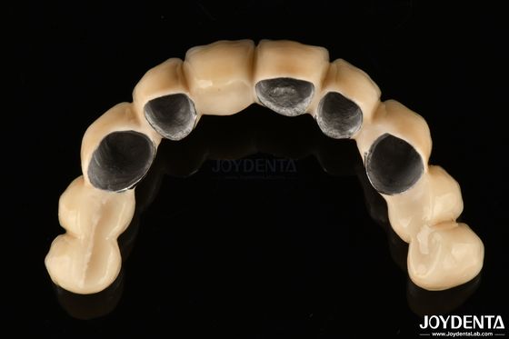 Céramique PFM fusionné à la couronne métallique hautement biocompatible et résistant à la corrosion