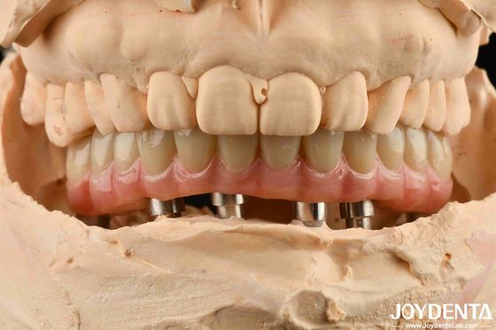 Pont hybride d'implants dentaires en titane esthétique pour la perfection dentaire