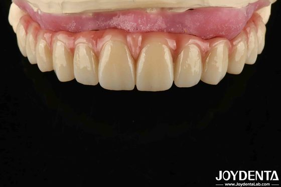 Confortable à porter Titane Malong Hybrid Bridge Dental réglable