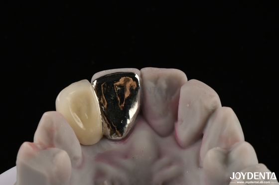 Le pont de Maryland est un pont dentaire métallique, avec une bonne fonction de mastication pour une réparation durable.