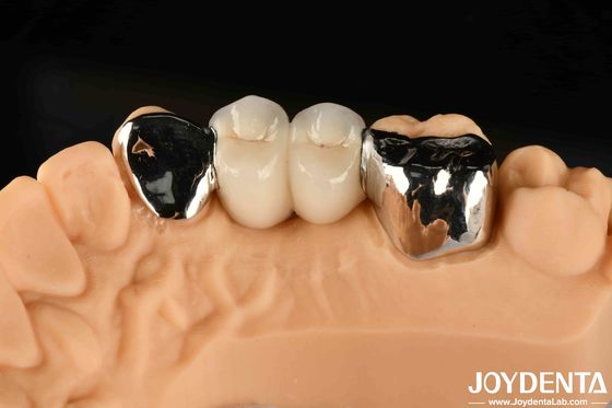 Métallique Dental Maryland Bonded Bridge Bon remède pour la réparation clinique orale
