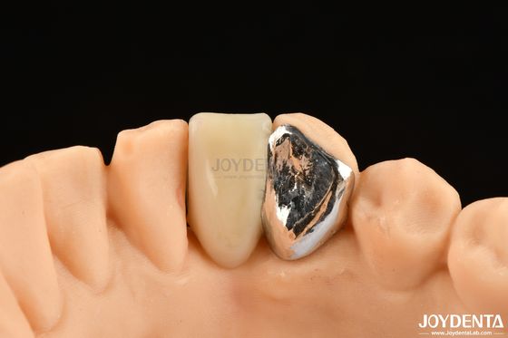 Idéal correspondant Clinical Bonding Maryland Dental Pour les travaux de réparation clinique orale