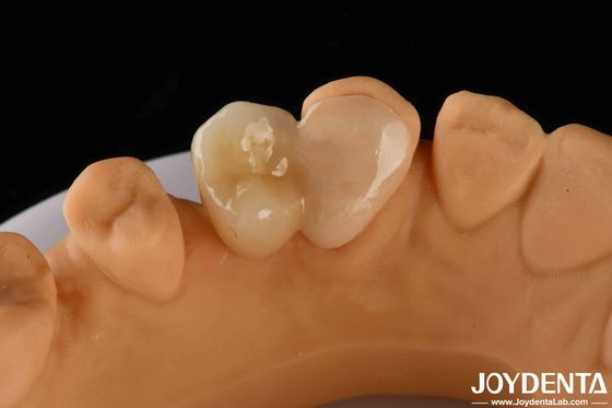 Emax Maryland Veneer adhésion de liaison clinique pour la réparation dentaire de couleur correspondante