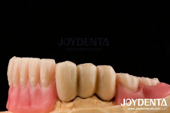 Prothèses en acier inoxydable Prothèses dentaires partielles Joints de surface polie Joints de boule