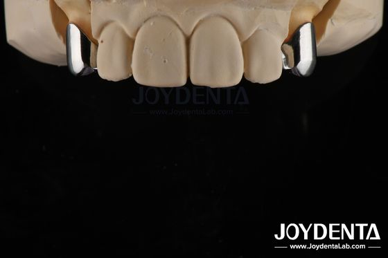 Prothèse amovible de précision Implants dentaires