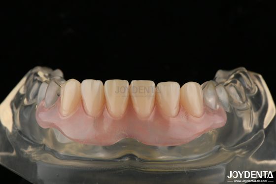 Une prothèse invisible personnalisée avec une technologie avancée d'aménagement dentaire