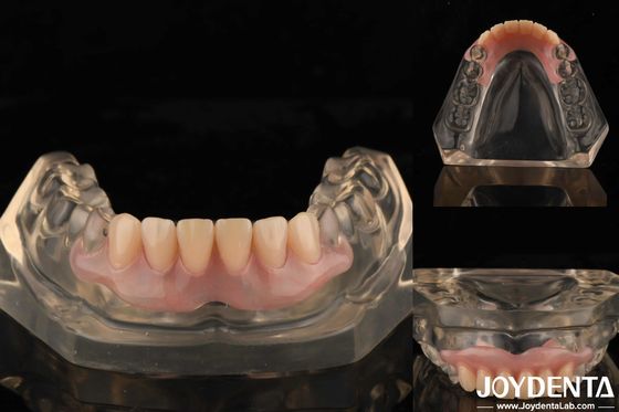 Technologie d'aménagement des dents Prothèse flexible Finition à haute élasticité Personnalisation