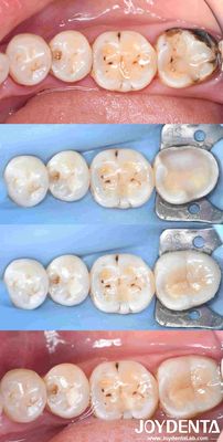 Restauration personnalisable de l'incrustation de porcelaine dentaire pour la réparation des dents parfaitement ajustées