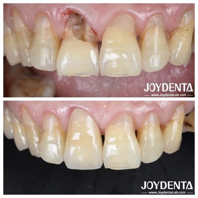 Dentiste à surface lisse Couronne en zirconium pour les restaurations postérieures et antérieures