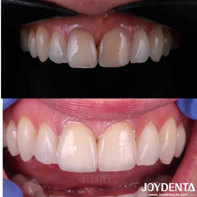 Veneurs dentaires à surface lisse pour les dents tortueuses, veneurs de porcelaine cosmétique sur mesure