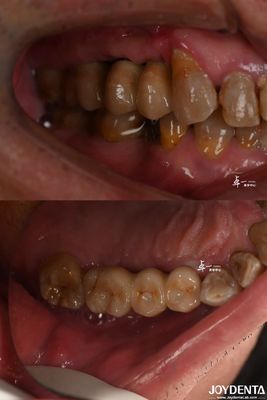 Implant dentaire à surface rugueuse pour matériau en titane au niveau des os sous-cristaux