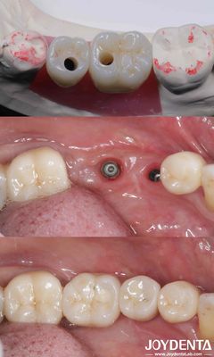 Implants dentaires en titane cylindriques tous sur 4 10-16 mm de longueur
