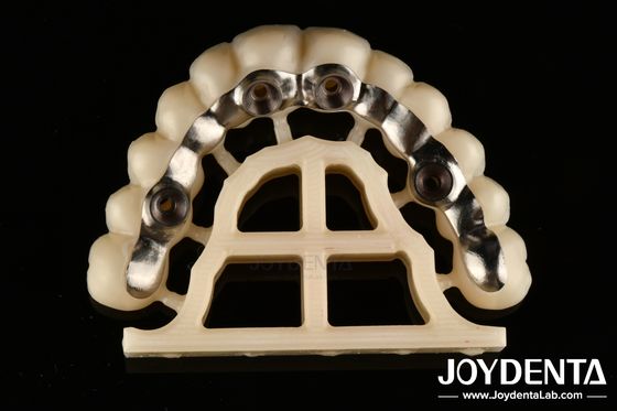 Finition en argent Abutments et barres personnalisés à vis de fixation précise ou à ciment