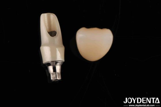 Dentistes en zirconie, abdominaux et barres personnalisés Restaurations dentaires pour l'anatomie individuelle du patient