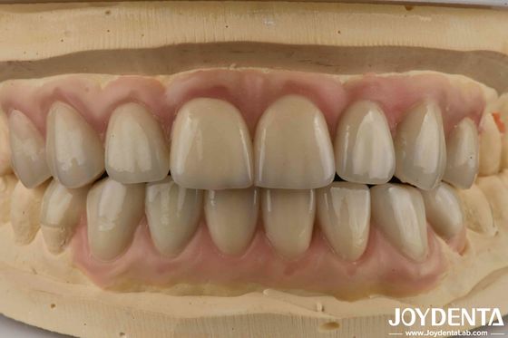 Émax hautement translucide, cosmétique, dentisterie, placage, esthétique, ultrafin