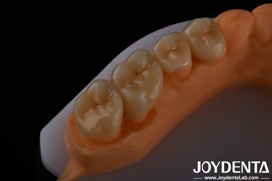 Haut esthétique Zirconia à contour complet Pour couronnes Ponts Implants Restaurations dentaires