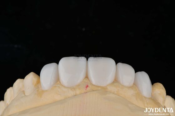 Matériau de porcelaine personnalisé Veneurs de dents Emax pour une liaison esthétique élevée