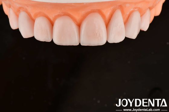 Fabriqué sur mesure IPS Porcelaine Emax Veneurs Restaurations dentaires Résistant aux fissures