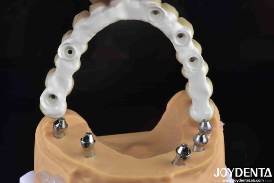 Solution dentaire hybride à base de Ti résistante aux fractures