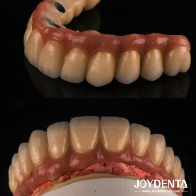 Coulée et fraisage PFM couronne dentaire, restauration dentaire couronne métallique en porcelaine fondue
