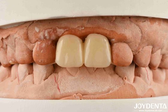 PMMA polyméthylmétacrylate multicouche pour les restaurations dentaires