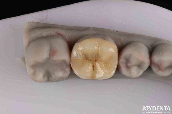 Inlay en zirconium personnalisable Onlay Préparation minimale pour la restauration des dents endommagées