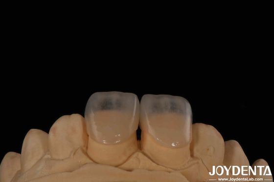 Éco-friendly Micro Dental Veneer pour dents d'épaisseur de 0,2 mm Texture lisse