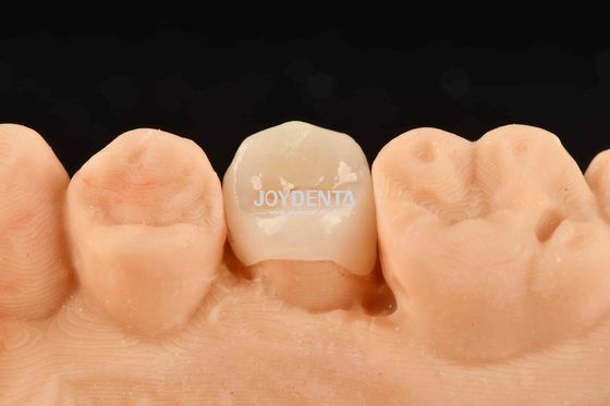 Inlay composite blanc personnalisable Onlay apparence naturelle Restauration des dents peu invasive