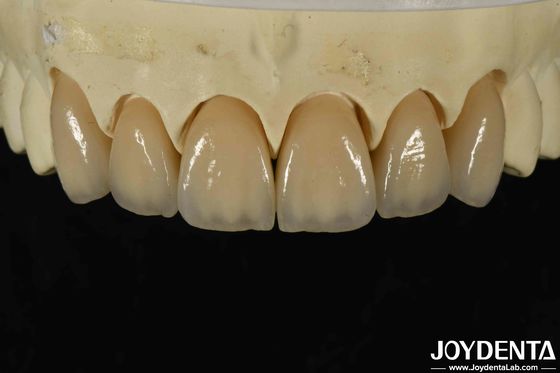Excellente biocompatibilité Zirconie en couches à haute esthétique et densité 6,0-6,1 G/cm3