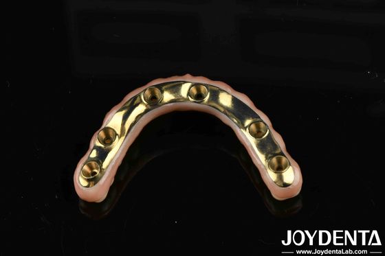 Pont hybride en zirconium en Ti-Bar sur mesure pour le confort et la durabilité dans les restaurations dentaires