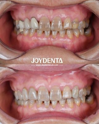 Circonia dentaire légère pour une expérience optimale du patient Transitions de couleur naturelles et biocompatibilité garantie