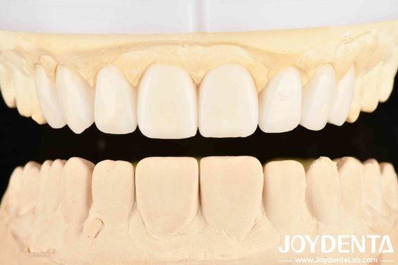 La bonne élasticité et la technologie d'aménagement des dents dans les soins dentaires