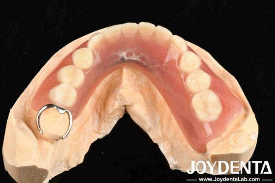 Métaux et résines cadre de finition des dents pour une structure buccale stable dans la configuration dentaire