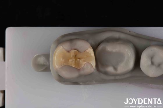 Cimentation sécurisée à faible translucide pour des restaurations durables et esthétiques