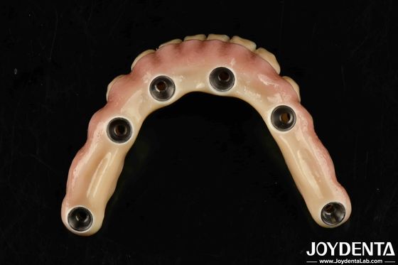 Ponte hybride en titane Malong pour soins dentaires