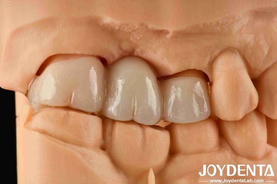 Expérience de couleur réaliste en zirconium complet avec une résistance élevée à la coloration et une résistance à la flexion de 1000 MPa