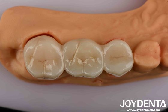 Zirconia dentaire à haute résistance Votre solution ultime pour une apparence naturelle